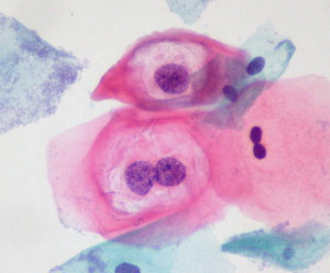 HPV-virus. Image: cc Ed Uthman 